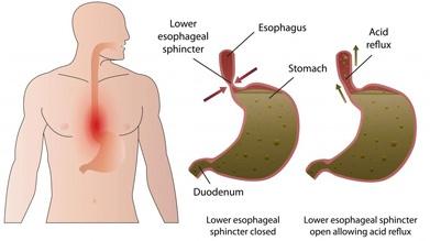 تغذیه برای افراد مبتلا سوزش سر دل (ریفلاکس معده)