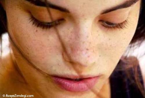 پنج روش برای از بین بردن لک های پوست