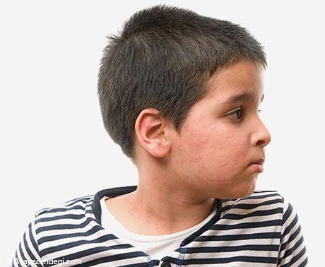  همه چیز درباره ضایعه های پوستی در کودکان 