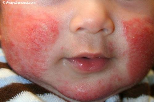 همه چیز درباره ضایعه های پوستی در کودکان همه چیز درباره ضایعه های پوستی در کودکان