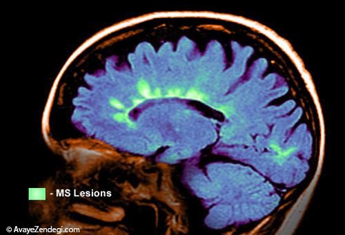  مراقب باشید اسکلروز چندگانه یا اِم اِس نگیرید 