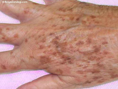لکه های روی پوست دست چطور ظاهر می شود؟